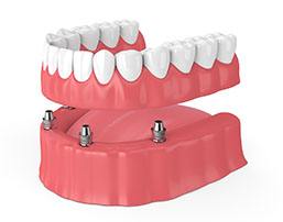 Model of an implant supported denture