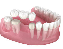 Illustration of traditional dental bridge in lower jaw with white background