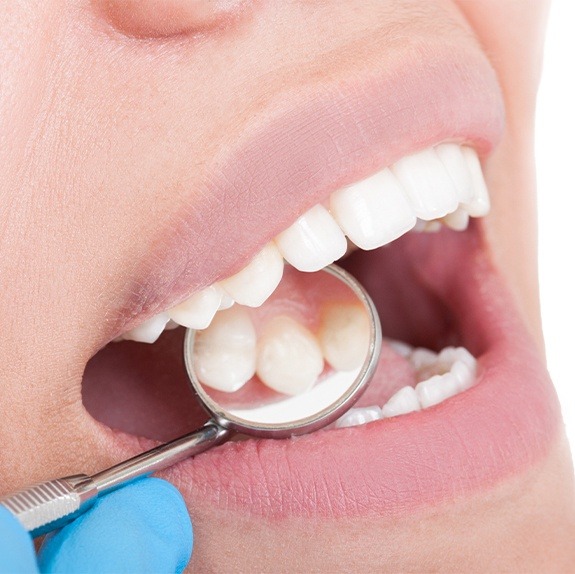 Healthy smile with natural looking tooth-colored fillings