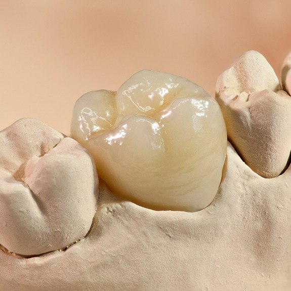 Model smile with dental crown restoration