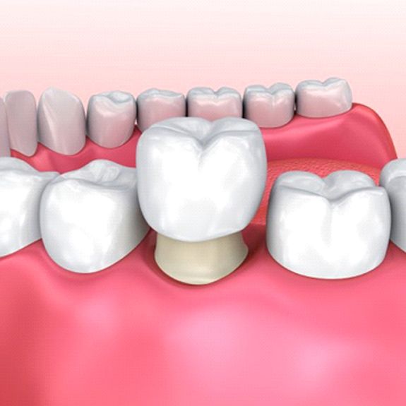diagram of dental crown being placed over bottom tooth