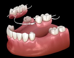 partial denture replacing multiple missing teeth along an arch