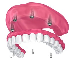 four dental implants supporting a full denture