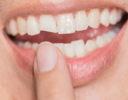 Closeup of smile chipped and broken front tooth