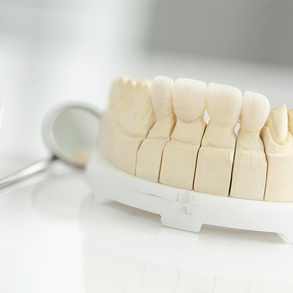Model smile with fixed bridge restoration