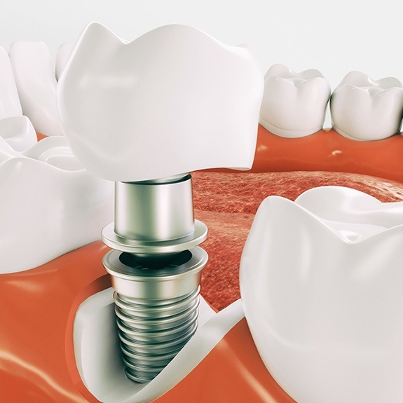 Animated implant supported dental crown placement