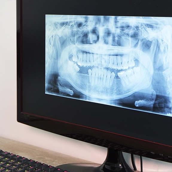 Digital dental x-rays on computer screen