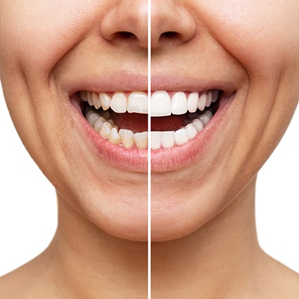 smiling woman with veneers in Grand Prairie against turquoise background 