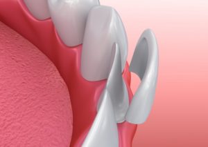 veneers 3D illustration 