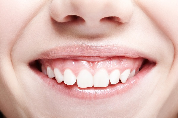 closeup of gummy smile 