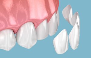 Rendering of veneers separated from teeth.